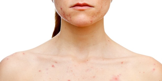 isotretinoin