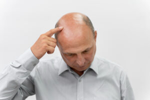 Minoxidil kan användas under lång tid så länge du inte får biverkningar och har nytta av behandlingen.